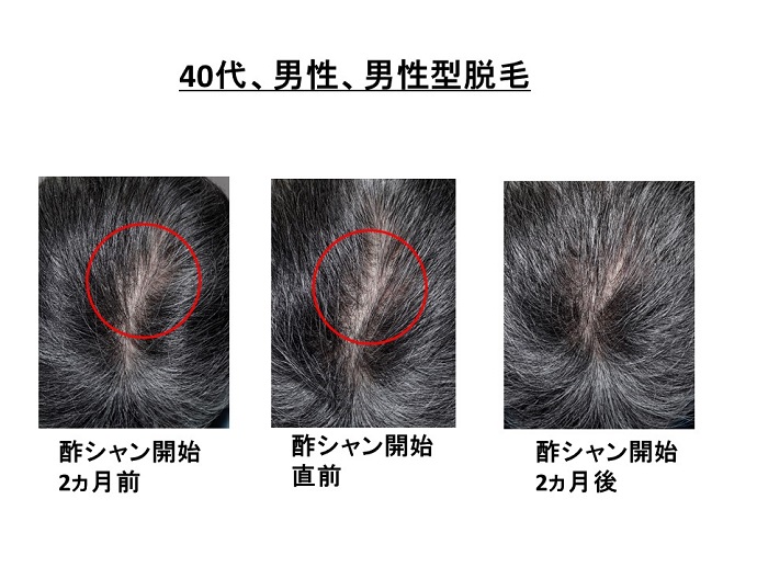 円形脱毛症　病院
